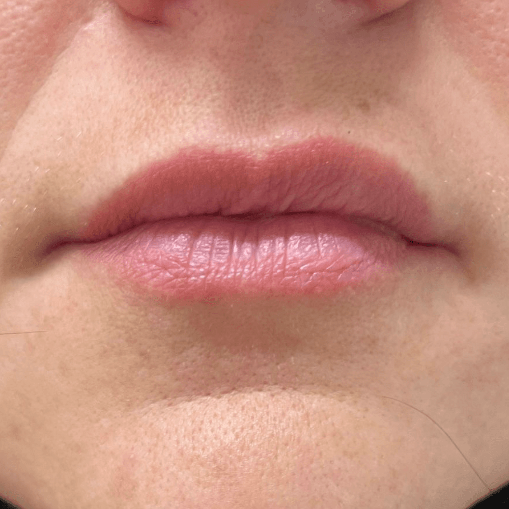 Lippen vor der Behandlung