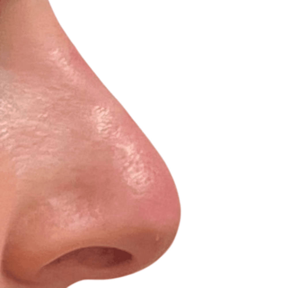 Nase nach der Behandlung