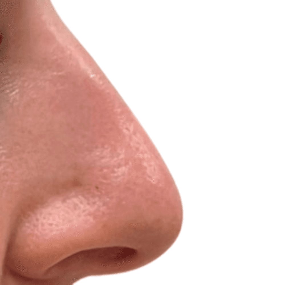 Nase vor der Behandlung